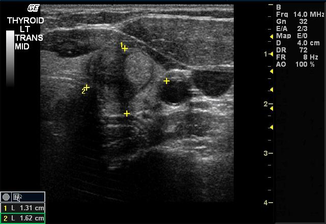 follicular thyroid cancer ultrasound