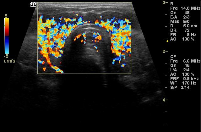 Thyroid Ultrasound Top 10 Pathology 9 Graves Disease