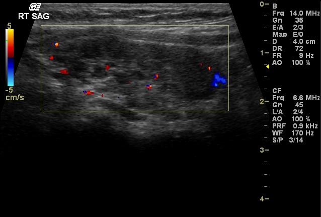 hashimotos thyroiditis ultrasound