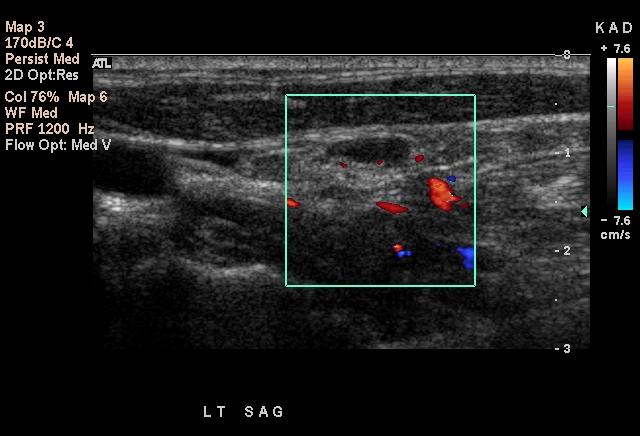 thyroid cancer ultrasound
