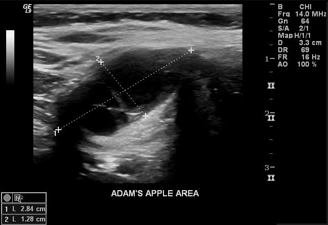 thyroglossal duct cyst ultrasound