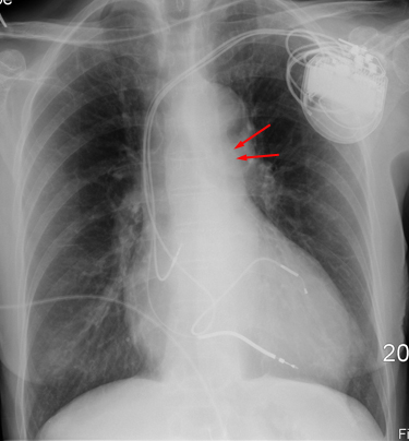 pulmonary veins xray