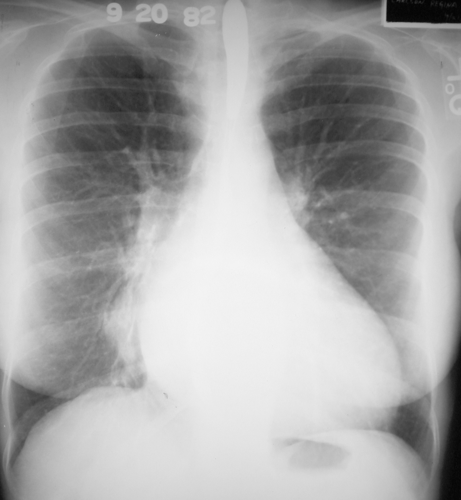 pulmonary hypertension xray