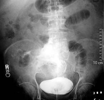 Urinary Tract Obstruction or Rupture