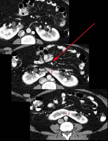 Horseshoe kidney, Radiology Reference Article